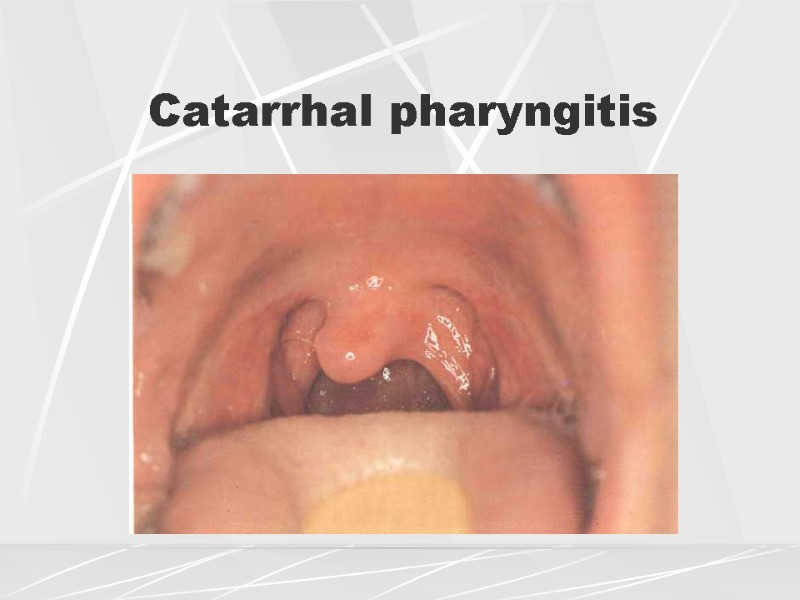 Catarrhal pharyngitis
